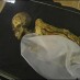“Donzela do Gelo” morreu com câncer de mama há 2.500 anos